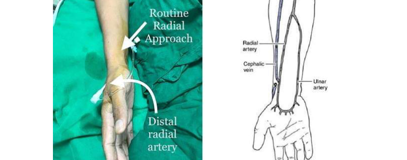 Distal Radial Access