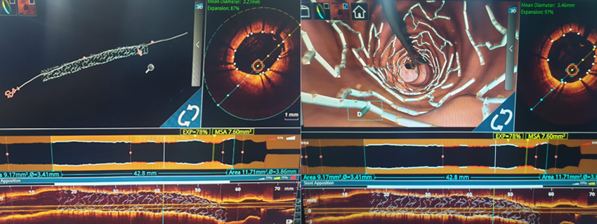 Optical Coherence Tomography