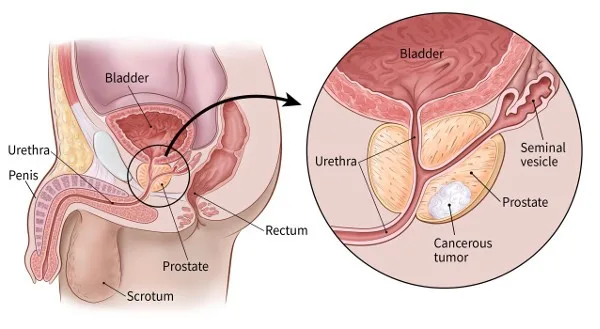 Prostate Cancer treatment in Mulund